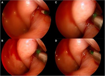 Balloon dilation of the eustachian tube using endovascular balloon under local anesthesia—a case series and systematic literature review